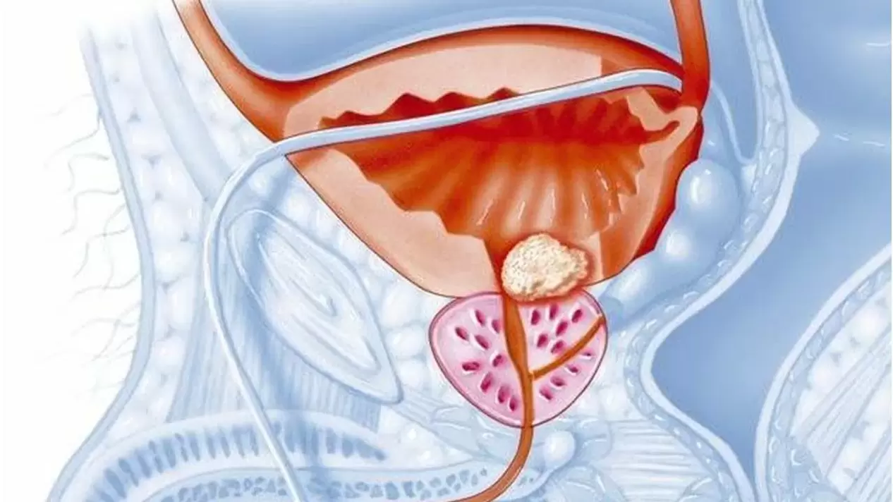 Maladie de la prostate chez les hommes