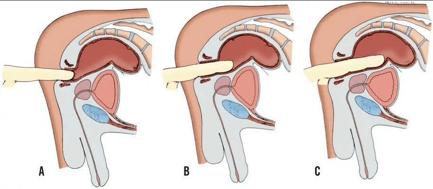 Examen rectal des doigts