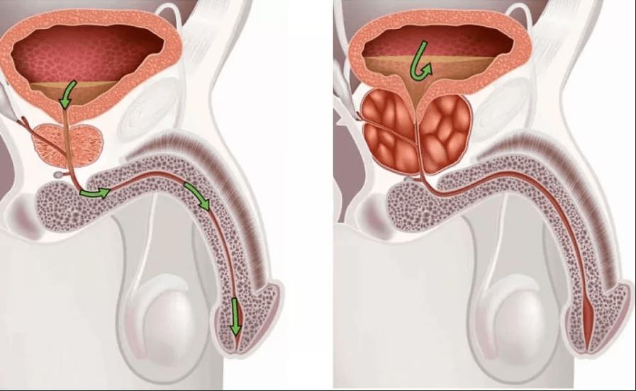 Symptômes de la prostatite